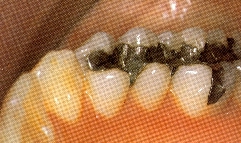ANTES